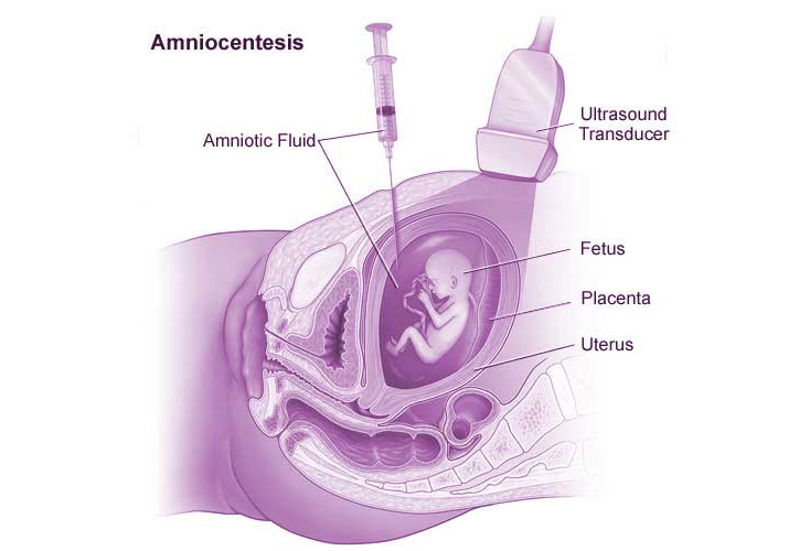 Amniocentesis: Under ultrasound guidance, doctors insert a needle through the abdomen of a pregnant mother to extract amniotic fluid from the uterus for testing